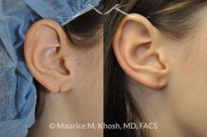 Photo of a patient before and after a procedure. Torn earlobe - repair of torn earlobe.