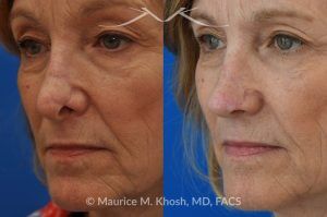 Photo of a patient before and after a procedure. Secondary repair of nostril retraction after attempted Mohs repair of the lower nose - This lovely 60 year-old had undergone repair of Mohs cancer removal from the left lower nose, by another surgeon. Unfortunately, this resulted in severe retraction of the left nostril and an unacceptable nasal deformity. 
Rhinoplasty to address nostril retraction was performed in Manhattan. Cartilage graft to the left nostril and composite graft (combination of skin and cartilage graft) to the inside edge of the nostril, helped to restore normality to the nose. The post op pictures are 6 months following her rhinoplasty.