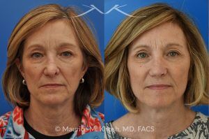Photo of a patient before and after a procedure. Secondary repair of nostril retraction after attempted Mohs repair of the lower nose - This lovely 60 year-old had undergone repair of Mohs cancer removal from the left lower nose, by another surgeon. Unfortunately, this resulted in severe retraction of the left nostril and an unacceptable nasal deformity. 
Rhinoplasty to address nostril retraction was performed in Manhattan. Cartilage graft to the left nostril and composite graft (combination of skin and cartilage graft) to the inside edge of the nostril, helped to restore normality to the nose. The post op pictures are 6 months following her rhinoplasty.