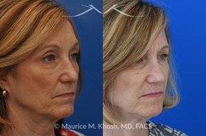 Photo of a patient before and after a procedure. Secondary repair of nostril retraction after attempted Mohs repair of the lower nose - This lovely 60 year-old had undergone repair of Mohs cancer removal from the left lower nose, by another surgeon. Unfortunately, this resulted in severe retraction of the left nostril and an unacceptable nasal deformity. 
Rhinoplasty to address nostril retraction was performed in Manhattan. Cartilage graft to the left nostril and composite graft (combination of skin and cartilage graft) to the inside edge of the nostril, helped to restore normality to the nose. The post op pictures are 6 months following her rhinoplasty.