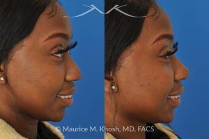 Photo of a patient before and after a procedure. Liquid rhinoplasty - This delightful patient was interested in improving the appearance of her nose without surgery. She disliked the droopy tip which became even more droopy when she smiled. She wanted more definition in the tip. Filler injections allowed us to improve the nasal tip position and shape, while a small injection into the bridge of the nose helped to eliminate the small hump. The patient was ecstatic with the results of her liquid rhinoplasty. 