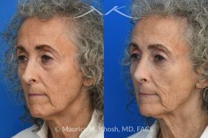 Photo of a patient before and after a procedure. Revision rhinoplasty with lower blepharoplasty 1 - This patient underwent revision rhinoplasty to improve nasal airflow, refine nasal tip symmetry, and achieve a natural, un-operated appearance. An open approach was used to place bilateral spreader grafts—double-layered on the left and single-layered on the right—fashioned from the septum. Ear cartilage was utilized as alar strut grafts to reshape and support the nasal tip, and septo-columellar sutures were used to improve columellar position. A cadaveric dermal graft was applied to the dorsum to create a smooth and natural contour. A lower eyelid blepharoplasty was performed simultaneously for added rejuvenation.