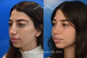Photo of a patient before and after a procedure. Rhinoplasty to Remove Dorsal Hump and Refine the Tip -  The patient sought to improve her nose's appearance, specifically aiming to reduce a prominent dorsal hump and achieve a more refined nasal tip. We utilized an open rhinoplasty approach, allowing for precise dorsal reduction and lateral osteotomies. We placed bilateral spreader grafts to preserve and support nasal airflow. We refined the tip using dome-binding sutures without removing cartilage, which maintained structural integrity. We carefully controlled the final tip position and projection using septo-columellar sutures, resulting in a balanced and natural contour.