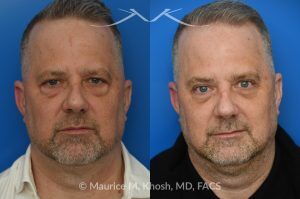 Photo of a patient before and after a procedure. Upper and Lower Blepharoplasty - This patient sought to improve the “tired” appearance of his eyes. He underwent upper blepharoplasty along with a lower blepharoplasty performed through a transconjunctival (inside the eyelid) approach. This combination effectively refreshed his overall look, restoring a more youthful and well-rested appearance while avoiding any visible external scarring on the lower eyelids.  
