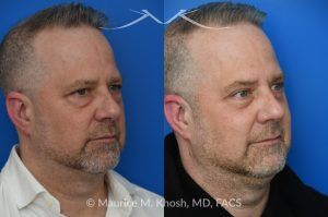 Photo of a patient before and after a procedure. Upper and Lower Blepharoplasty - This patient sought to improve the “tired” appearance of his eyes. He underwent upper blepharoplasty along with a lower blepharoplasty performed through a transconjunctival (inside the eyelid) approach. This combination effectively refreshed his overall look, restoring a more youthful and well-rested appearance while avoiding any visible external scarring on the lower eyelids.  