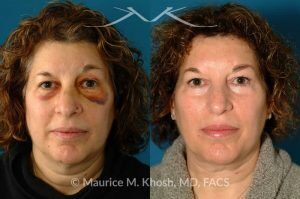 Photo of a patient before and after a procedure. Nose Fracture - before and after results.