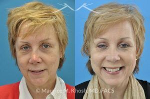 Photo of a patient before and after a procedure. Nose Fracture - before and after results.