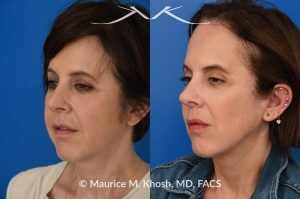 Photo of a patient before and after a procedure. Short-Flap Facelift with Buccal Fat Removal - This 54-year-old was unhappy with the 'heavy' and aged appearance of her lower face. A combination of short-flap facelift and buccal fat removal (performed under local anesthesia) was used to restore the  youthful and heart-shaped contour of the lower face.