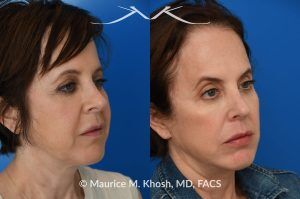 Photo of a patient before and after a procedure. Short-Flap Facelift with Buccal Fat Removal - This 54-year-old was unhappy with the 'heavy' and aged appearance of her lower face. A combination of short-flap facelift and buccal fat removal (performed under local anesthesia) was used to restore the  youthful and heart-shaped contour of the lower face.