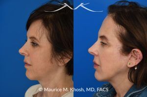 Photo of a patient before and after a procedure. Short-Flap Facelift with Buccal Fat Removal - This 54-year-old was unhappy with the 'heavy' and aged appearance of her lower face. A combination of short-flap facelift and buccal fat removal (performed under local anesthesia) was used to restore the  youthful and heart-shaped contour of the lower face.
