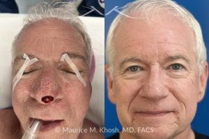 Photo of a patient before and after a procedure. Mohs Excision of Nasal Tip BCC with Local Flap Repair - This lovely patient underwent Mohs excision of basal cell carcinoma of the nasal tip. The defect was repaired with a local flap of nasal skin. The surgery actually helped to improve the nasal appearance by slightly elevating the tip. 