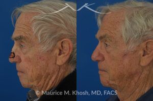 Photo of a patient before and after a procedure. Mohs repair of nose skin cancer with forehead flap - before and after photos.