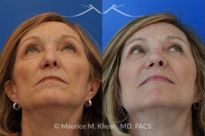 Photo of a patient before and after a procedure. Secondary repair of nostril retraction after attempted Mohs repair of the lower nose - This lovely 60 year-old had undergone repair of Mohs cancer removal from the left lower nose, by another surgeon. Unfortunately, this resulted in severe retraction of the left nostril and an unacceptable nasal deformity. 
Rhinoplasty to address nostril retraction was performed in Manhattan. Cartilage graft to the left nostril and composite graft (combination of skin and cartilage graft) to the inside edge of the nostril, helped to restore normality to the nose. The post op pictures are 6 months following her rhinoplasty.