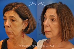 Photo of a patient before and after a procedure. Endoscopic Brow Lift with Revision SMAS Facelift and Eyelid Surgery - This 65 year old lady had previously undergone a facelift operation at age 48. She was unhappy with the aged appearance of her brow, eyes, mouth, and neck which made her look tired and sad. She underwent Revision SMAS facelift, endoscopic brow lift, upper and lower blepharoplasty.
