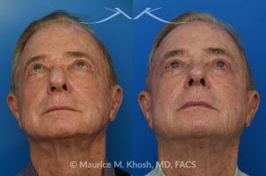 Photo of a patient before and after a procedure. Comprehensive Rhinoplasty and Brow Symmetry Restoration After Forehead Flap Reconstruction - This gentleman sought consultation for enhancement of the nose and increased symmetry in the position of his eyebrows. He had previously undergone excision of a large skin cancer from the right lower nose which was reconstructed with a left forehead flap (skin from the forehead was moved to the nose to cover the surgical defect). The flap resulted in a puffy appearing lower nose and exacerbated the droopy and deviated appearing nasal tip. Additionally, skin removal from the forehead elevated the position of the left eyebrow and resulted in a wide scar in the left upper forehead. 
During rhinoplasty surgery, the contour of the bridge and the tip of was improved and the puffy appearing flap was thinned. The brow lift surgery helped to elevate the right brow to match the position of the left eyebrow. The wide scar in the left forehead was eliminated. 