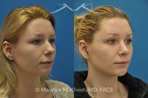Photo of a patient before and after a procedure. Rhinoplasty and chin implant - before and after photo.