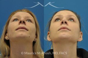 Photo of a patient before and after a procedure. Rhinoplasty and chin implant - before and after photo.
