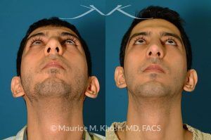 Photo of a patient before and after a procedure. Rhinoplasty and chin implant - before and after photo.