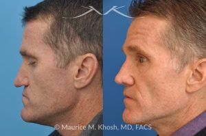 Photo of a patient before and after a procedure. Revision rhinoplasty utilizing rib cartilage - This gentleman who had previously undergone rhinoplasty complained of droopy tip, nose obstruction, and asymmetric appearance of the tip. Revision rhinoplasty utilizing rib cartilage, performed through the open approach allowed restoration of the nasal tip symmetry, improved breathing, and normal tip position.