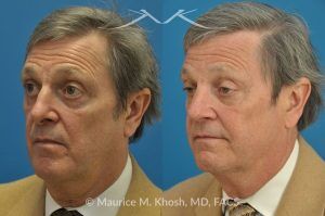 Photo of a patient before and after a procedure. Revision open approach rhinoplasty with septum cartilage graft - Previous rhinoplasty in this gentleman had caused nasal obstruction, pinched and retracted nostrils, and excess columellar show. Revision open approach rhinoplasty with septum cartilage graft allowed restoration of breathing, and creation of a natural and harmonious appearing nose.