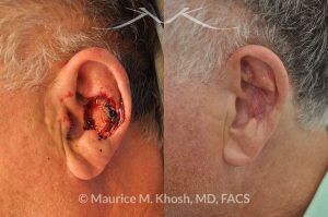 Photo of a patient before and after a procedure. Moh's repair of the ear with skin graft and composite graft - before and after photos.