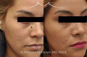 Photo of a patient before and after a procedure. Mole (nevus) removal from the face - before and after results.