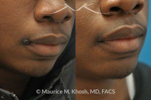 Photo of a patient before and after a procedure. Mole removal from the corner of the mouth - before and after results.