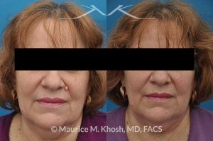 Photo of a patient before and after a procedure. Mole removal from the left upper lip near the nose - before and after results.