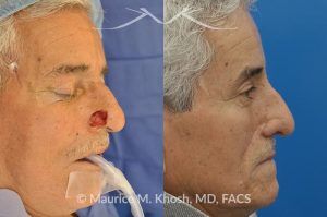 Photo of a patient before and after a procedure. Picture of skin cancer of nose before removal, after Moh's surgery, and following reconstruction - This 69 year old gentleman had Basal Cell Carcinoma of the skin of the right nasal lobule (shown on the left side). The skin cancer was removed via the Mohs technique resulting in near total loss of the right nasal ala (central picture). The nose was reconstructed in a two stage operation utilizing a right nasolabial flap and cartilage graft. The final results are shown on the right side of the picture.