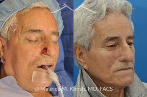 Photo of a patient before and after a procedure. Picture of skin cancer of nose before removal, after Moh's surgery, and following reconstruction - This 69 year old gentleman had Basal Cell Carcinoma of the skin of the right nasal lobule (shown on the left side). The skin cancer was removed via the Mohs technique resulting in near total loss of the right nasal ala (central picture). The nose was reconstructed in a two stage operation utilizing a right nasolabial flap and cartilage graft. The final results are shown on the right side of the picture.