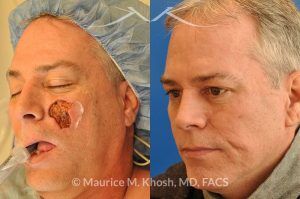 Photo of a patient before and after a procedure. Cheek reconstruction - before and after photos.