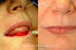 Photo of a patient before and after a procedure. Lip reconstruction with mucosa flap after Mohs cancer removal - before and after photos.