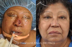 Photo of a patient before and after a procedure. Nasal reconstruction with bilateral midline advancement flaps - before and after photos.