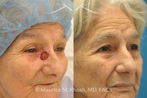 Photo of a patient before and after a procedure. Moh's skin cancer repair of nose - before and after photos.