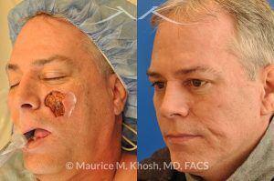 Photo of a patient before and after a procedure. Cheek reconstruction - before and after results.