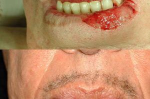 Photo of a patient before and after a procedure. Repair of lower lip defect with lining flap from inside the mouth - before and after photos.