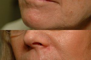 Photo of a patient before and after a procedure. Upper lip repair with advancement flaps - before and after photos.