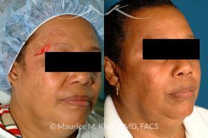 Photo of a patient before and after a procedure. Repair of brow defect - before and after photos.