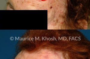 Photo of a patient before and after a procedure. Repair of large forehead defect - before and after photos.