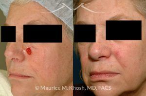 Photo of a patient before and after a procedure. Mohs defect of the medial cheek repaired with a local advancement flap - before and after photos.