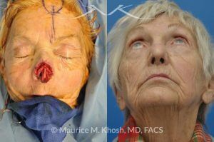 Photo of a patient before and after a procedure. Nose Moh's skin cancer repair, utilizing forehead flap and ear cartilage graft - before and after photos.