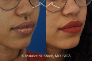 Photo of a patient before and after a procedure. Mole removal from upper lip - before and after results.