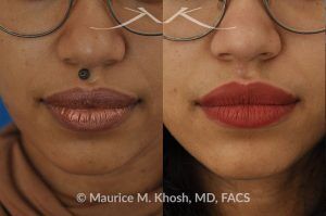 Photo of a patient before and after a procedure. Mole removal from upper lip - before and after results.