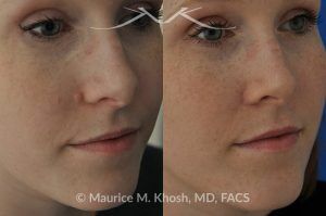 Photo of a patient before and after a procedure. Mole removal from cheek skin near the nose - before and after results.