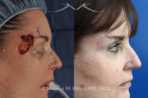 Photo of a patient before and after a procedure. Mohs Defect Repair of the Right Temple and Forehead - This delightful patient was referred for repair of a Moh's defect following excision of a basal cell cancer from the right temple and forehead. Repair was accomplished with a flap repair. The post op results demonstrate her at 6 months following repair. 