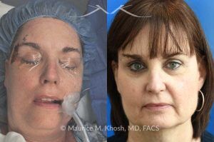Photo of a patient before and after a procedure. Mohs Defect Repair of the Right Temple and Forehead - This delightful patient was referred for repair of a Moh's defect following excision of a basal cell cancer from the right temple and forehead. Repair was accomplished with a flap repair. The post op results demonstrate her at 6 months following repair. 