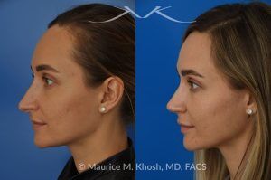 Photo of a patient before and after a procedure. Rhinoplasty to Elevate and Refine the Nasal Tip - This delightful 30 year-old was interested in rhinoplasty in New York, to elevate and refine her nasal tip. An open approach rhinoplasty was used to rotate and shorten the tip. Providing the results which perfectly matched her expectations .