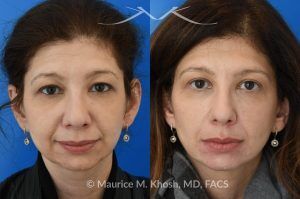 Photo of a patient before and after a procedure. Upper Eyelid Lift (Upper Blepharoplasty) - This 45 year old was interested in upper eyelid lift in Manhattan to address heavy and tired appearing upper eyelids. Upper blepharoplasty was carried out under local anesthesia as an office procedure. She had minimal bruising and no pain during her recovery. She is ecstatic with her results. 