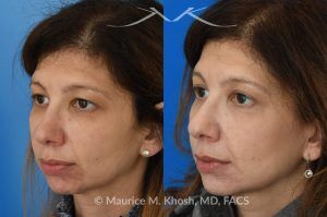 Photo of a patient before and after a procedure. Upper Eyelid Lift (Upper Blepharoplasty) - This 45 year old was interested in upper eyelid lift in Manhattan to address heavy and tired appearing upper eyelids. Upper blepharoplasty was carried out under local anesthesia as an office procedure. She had minimal bruising and no pain during her recovery. She is ecstatic with her results. 