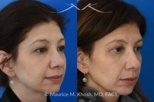 Photo of a patient before and after a procedure. Upper Eyelid Lift (Upper Blepharoplasty) - This 45 year old was interested in upper eyelid lift in Manhattan to address heavy and tired appearing upper eyelids. Upper blepharoplasty was carried out under local anesthesia as an office procedure. She had minimal bruising and no pain during her recovery. She is ecstatic with her results. 
